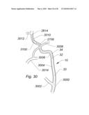 SYSTEMS AND METHODS FOR REMOVING OBSTRUCTIVE MATTER FROM BODY LUMENS AND TREATING VASCULAR DEFECTS diagram and image