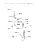 SYSTEMS AND METHODS FOR REMOVING OBSTRUCTIVE MATTER FROM BODY LUMENS AND TREATING VASCULAR DEFECTS diagram and image