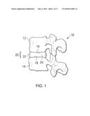 Methods, Systems, and Devices for Treating Intervertebral Discs Including Intradiscal Fluid Evacuation diagram and image