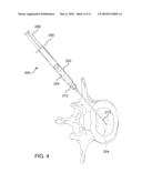 Methods, Systems, and Devices for Treating Intervertebral Discs Including Intradiscal Fluid Evacuation diagram and image