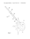 Methods, Systems, and Devices for Treating Intervertebral Discs Including Intradiscal Fluid Evacuation diagram and image