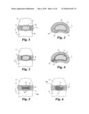 Intervertebral Disc Nucleus Implants and Methods diagram and image