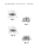 Intervertebral Disc Nucleus Implants and Methods diagram and image