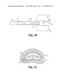 Intervertebral Disc Nucleus Implants and Methods diagram and image