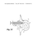 Intervertebral Disc Nucleus Implants and Methods diagram and image