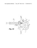 Intervertebral Disc Nucleus Implants and Methods diagram and image