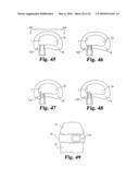 Intervertebral Disc Nucleus Implants and Methods diagram and image