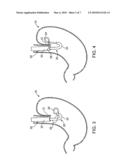 Assemblies for deploying fasteners in tissue and snares for use in such assemblies diagram and image