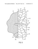 Soft Tissue Attachment Device diagram and image