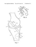 Soft Tissue Attachment Device diagram and image