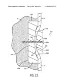 Soft Tissue Attachment Device diagram and image