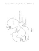 INTESTINAL SLEEVE diagram and image