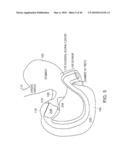 INTESTINAL SLEEVE diagram and image