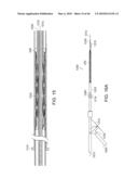 INTESTINAL SLEEVE diagram and image