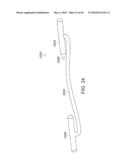 INTESTINAL SLEEVE diagram and image