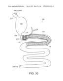 INTESTINAL SLEEVE diagram and image