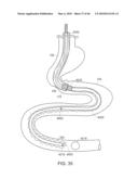 INTESTINAL SLEEVE diagram and image