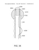 INTESTINAL SLEEVE diagram and image