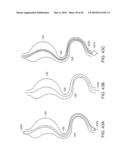 INTESTINAL SLEEVE diagram and image