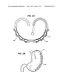 AUTOMATICALLY ADJUSTING INTRA-GASTRIC SATIATION AND SATIETY CREATION DEVICE diagram and image