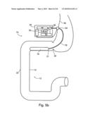 DUODENAL STIMULATION DEVICES AND METHODS FOR THE TREATMENT OF CONDITIONS RELATING TO EATING DISORDERS diagram and image