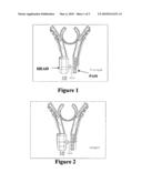 Snap-Off Diet Aid.TM. tragus clip with single-point removable pressure head diagram and image