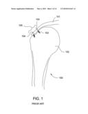 T-TYPE SUTURE ANCHOR diagram and image