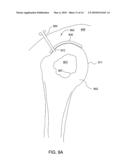 T-TYPE SUTURE ANCHOR diagram and image