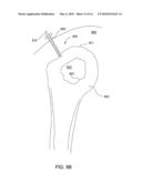 T-TYPE SUTURE ANCHOR diagram and image