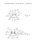 EXTENSION LIMITING DEVICES AND METHODS OF USE FOR THE SPINE diagram and image