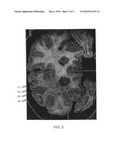 METHOD OF TREATING DEPRESSION, MOOD DISORDERS AND ANXIETY DISORDERS USING NEUROMODULATION diagram and image