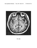 METHOD OF TREATING DEPRESSION, MOOD DISORDERS AND ANXIETY DISORDERS USING NEUROMODULATION diagram and image