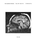 METHOD OF TREATING DEPRESSION, MOOD DISORDERS AND ANXIETY DISORDERS USING NEUROMODULATION diagram and image