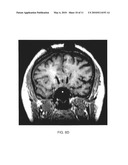 METHOD OF TREATING DEPRESSION, MOOD DISORDERS AND ANXIETY DISORDERS USING NEUROMODULATION diagram and image