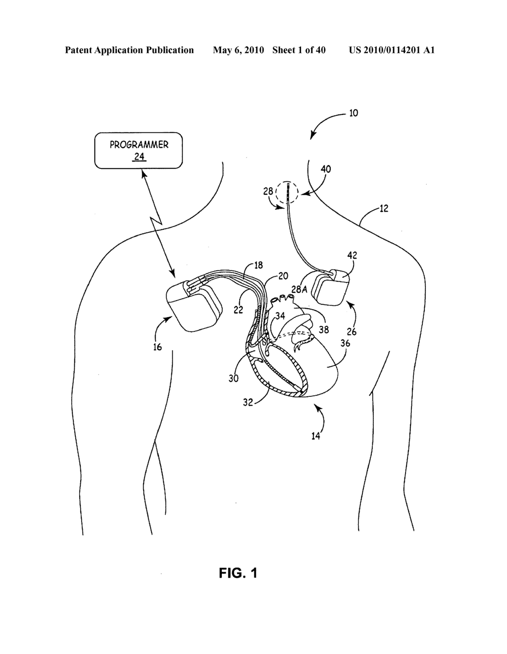 IMPLANTABLE MEDICAL DEVICE CROSSTALK EVALUATION AND MITIGATION - diagram, schematic, and image 02