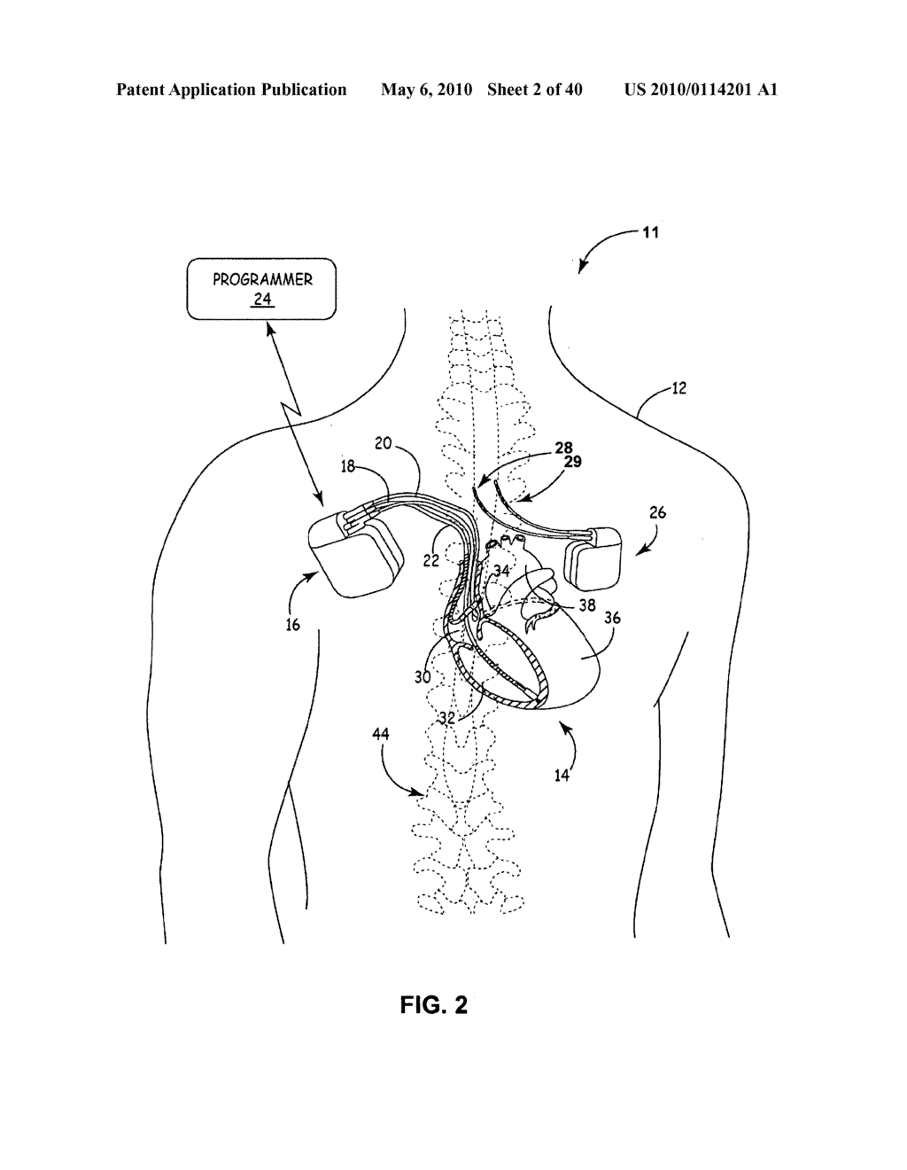 IMPLANTABLE MEDICAL DEVICE CROSSTALK EVALUATION AND MITIGATION - diagram, schematic, and image 03