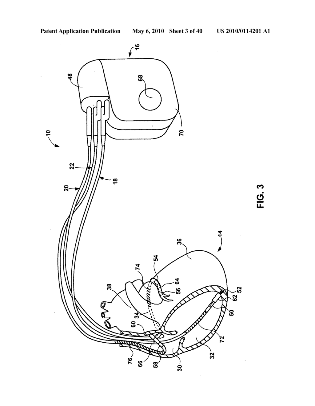 IMPLANTABLE MEDICAL DEVICE CROSSTALK EVALUATION AND MITIGATION - diagram, schematic, and image 04