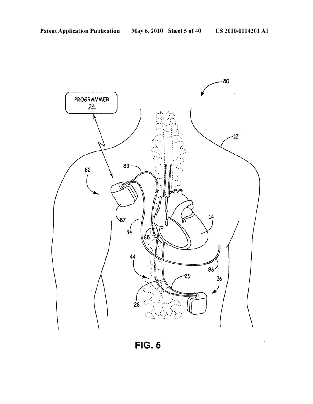 IMPLANTABLE MEDICAL DEVICE CROSSTALK EVALUATION AND MITIGATION - diagram, schematic, and image 06