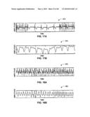 IMPLANTABLE MEDICAL DEVICE CROSSTALK EVALUATION AND MITIGATION diagram and image