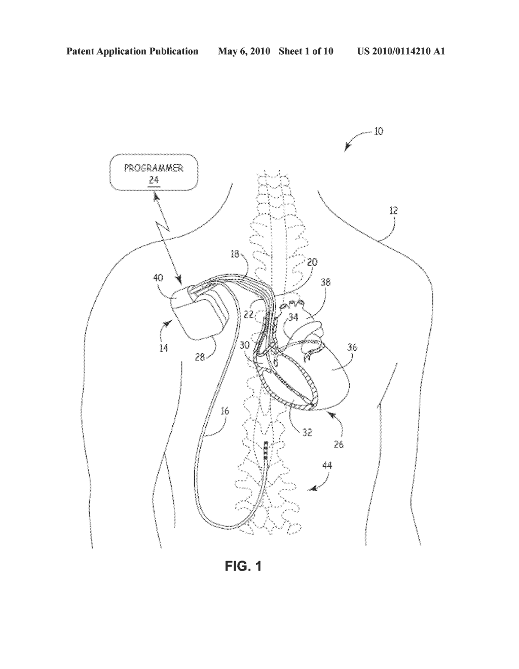 IMPLANTABLE MEDICAL DEVICE LEAD CONNECTION ASSEMBLY - diagram, schematic, and image 02