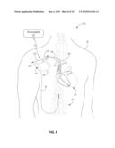 IMPLANTABLE MEDICAL DEVICE LEAD CONNECTION ASSEMBLY diagram and image