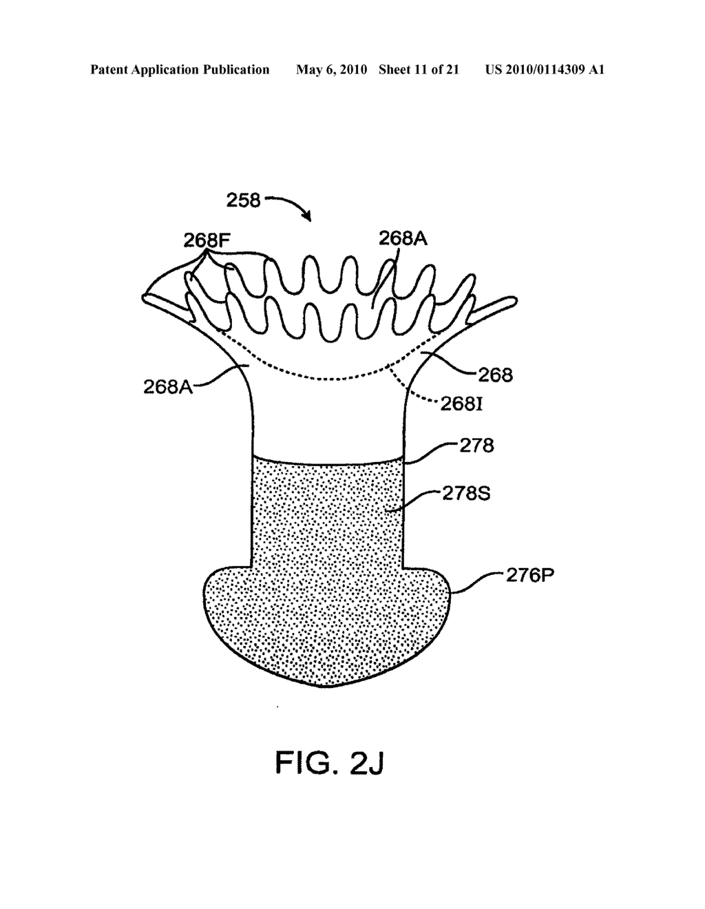 DRUG DELIVERY IMPLANTS FOR INHIBITION OF OPTICAL DEFECTS - diagram, schematic, and image 12