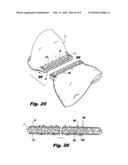 INTERLOCKING BUTTRESS MATERIAL RETENTION SYSTEM diagram and image