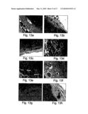 PHARMACEUTICAL COMPOSITIONS AND METHODS USEFUL FOR MODULATING ANGIOGENESIS, INHIBITING METASTASIS AND TUMOR FIBROSIS, AND ASSESSING THE MALIGNANCY OF COLON CANCER TUMORS diagram and image