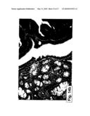 PHARMACEUTICAL COMPOSITIONS AND METHODS USEFUL FOR MODULATING ANGIOGENESIS, INHIBITING METASTASIS AND TUMOR FIBROSIS, AND ASSESSING THE MALIGNANCY OF COLON CANCER TUMORS diagram and image