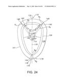 DENTAL IMPLANT diagram and image