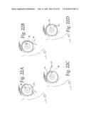 APPARATUS FOR REDUCING PRESSURE IN AN ORGAN diagram and image