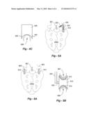 PEDICLE AND NON-PEDICLE BASED INTERSPINOUS AND LATERAL SPACERS diagram and image