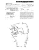 Method of preparing a femur for implantation of a femoral implant diagram and image