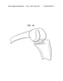 Method of preparing a femur for implantation of a femoral implant diagram and image